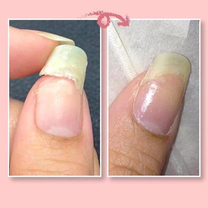🔥2023 Hot Sale🔥NAIL REPAIR PROTECTION GEL